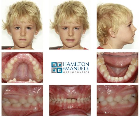 Child Airway - Hamilton & Manuele Orthodontics